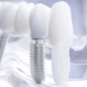 Immediate Implant In Clinical Practice