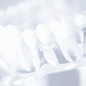 Restoration of Root Canal Treated Teeth