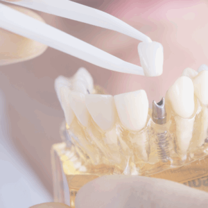 Treatment Planning Involving Dental Implants